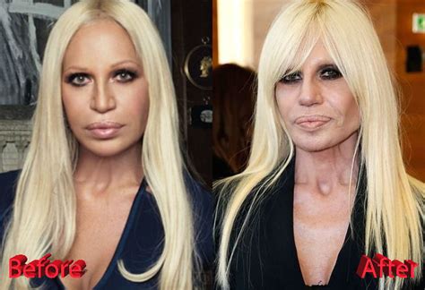 donatella versace 2020|donatella versace before and after.